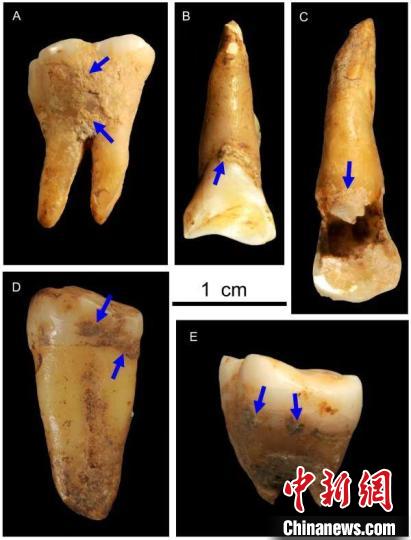 湖南道縣福岩洞8-12萬年前古人類的牙結石。　吳妍 供圖