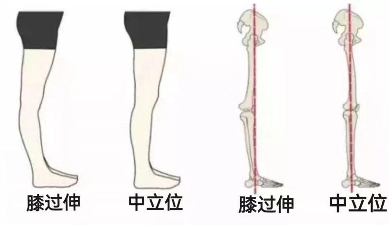 膝过伸是什么?